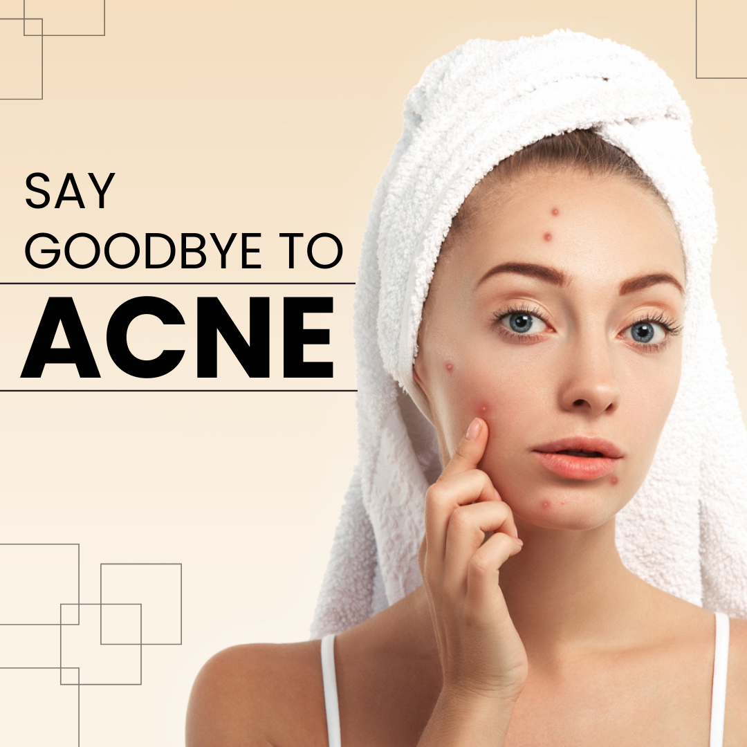 Natural Acne Treatment