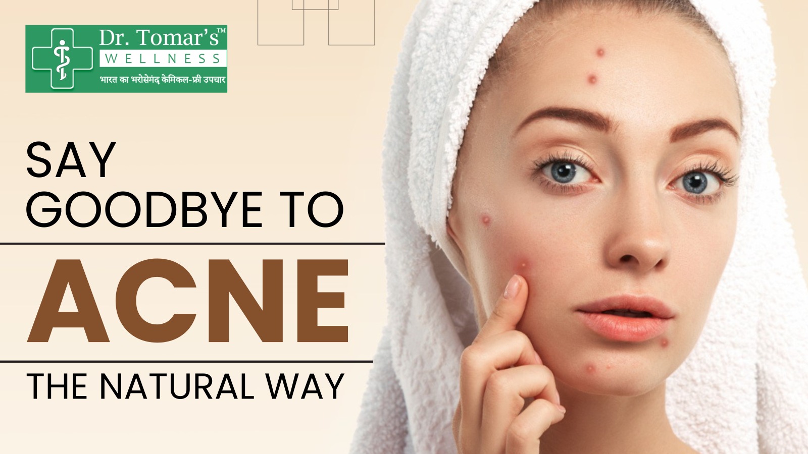 Natural Remedies for Acne