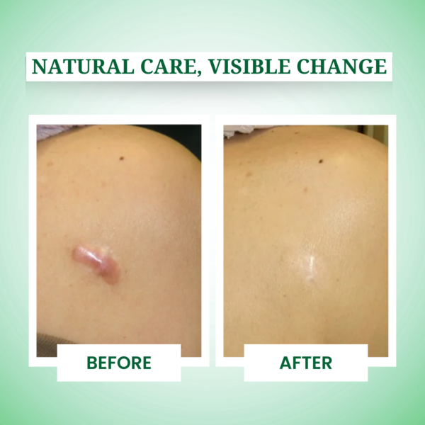 Keloid Control Cream
