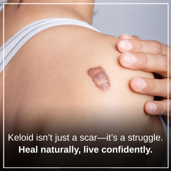 Keloid Ease Herbal Drop