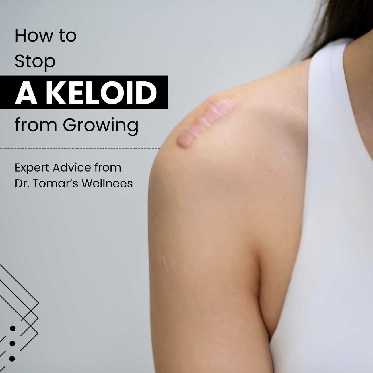 How to remove keloids fast