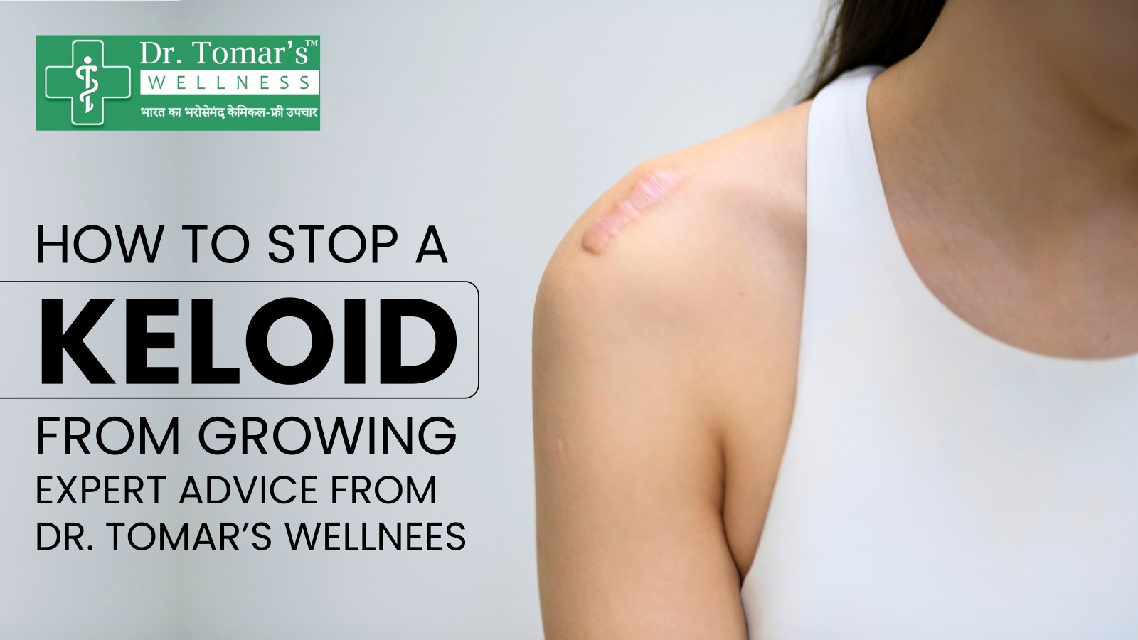 How to Stop a Keloid from Growing