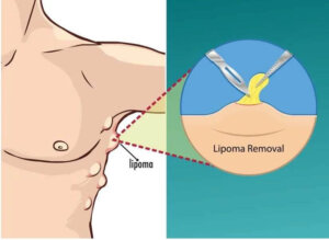 Lipoma Treatment Image 2
