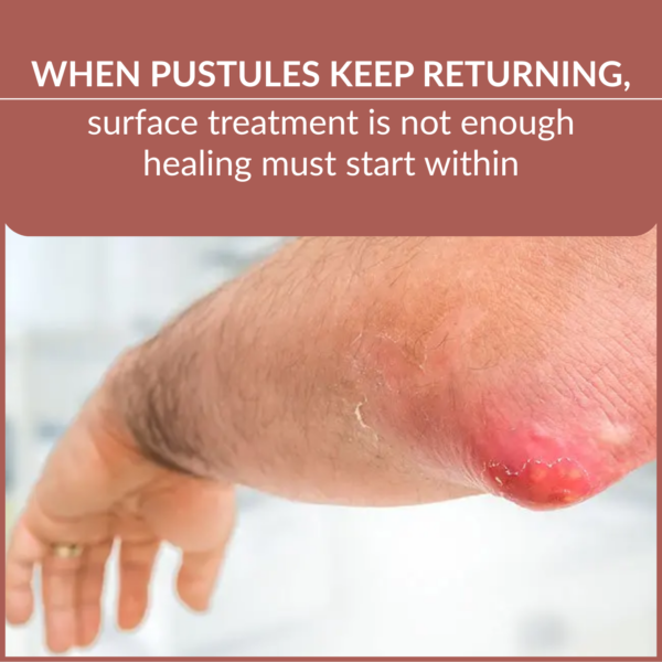 pustule