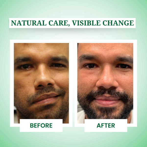 facial paralysis