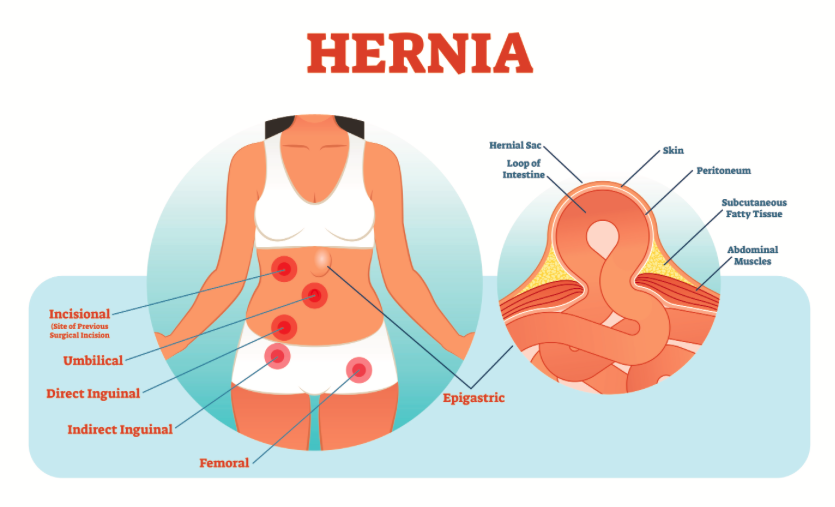 hernia care