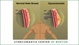 Gynecomastia vs Chest Fat