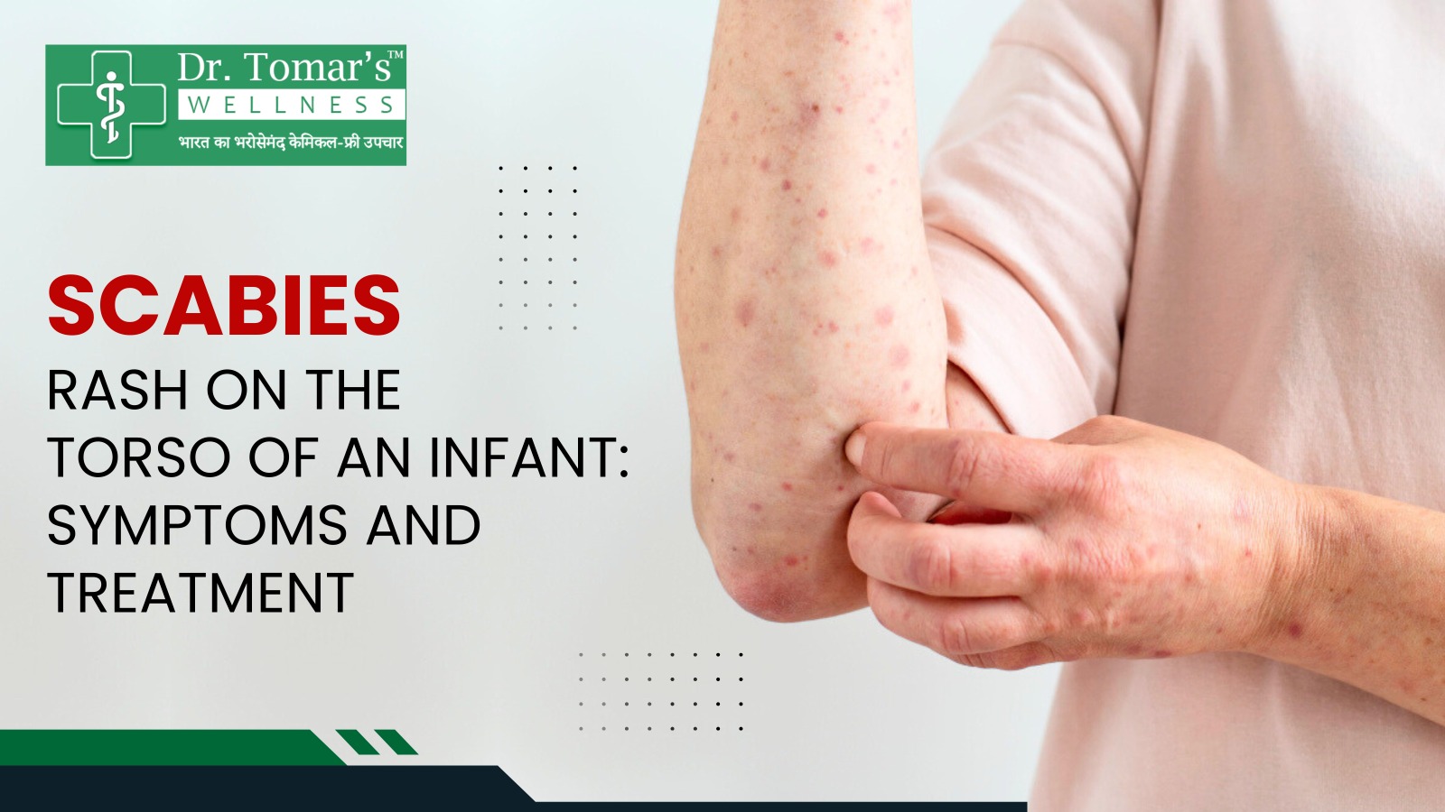 Scabies rash on the torso of an infant