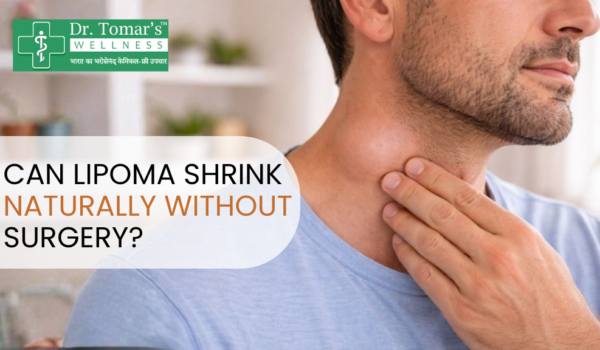 लाइपोमा को बिना ऑपरेशन के कैसे हटाएं
