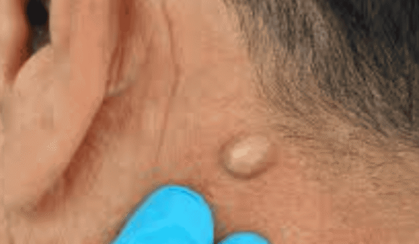 Lipoma Treatment in Pune