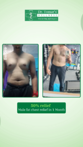 Lipoma Treatment in Patna, Bihar