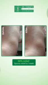 Lipoma Treatment in Patna, Bihar