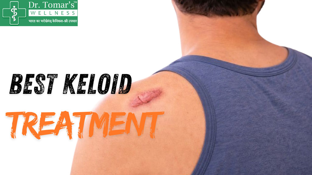 Best Keloid Treatment in Gujarat 1 Best Keloid Treatment in Gujarat