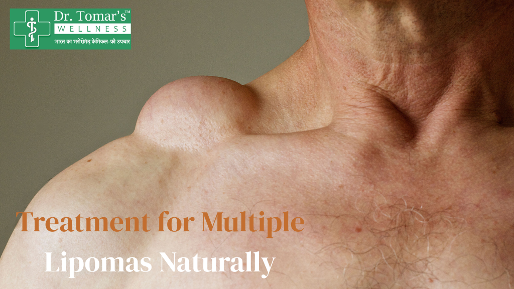 Treatment for Multiple Lipomas Naturally 1 Treatment for Multiple Lipomas