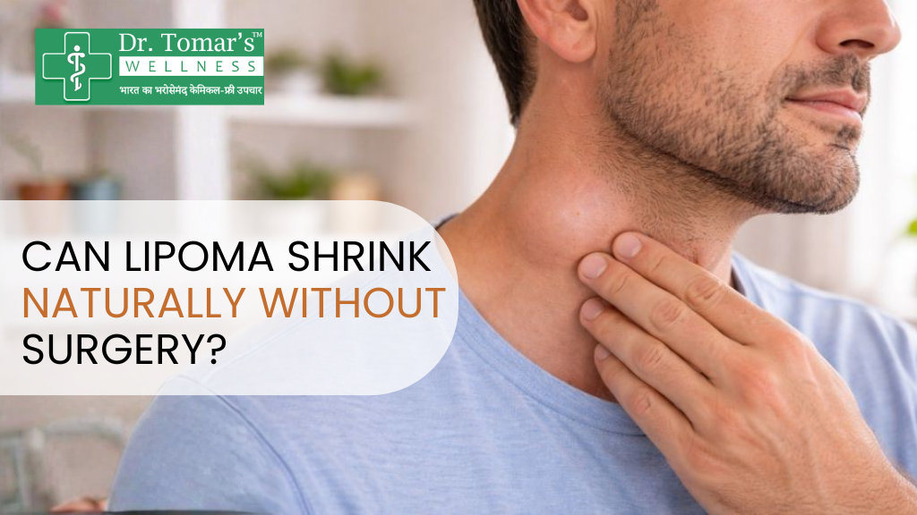 Lipoma Shrink Naturally