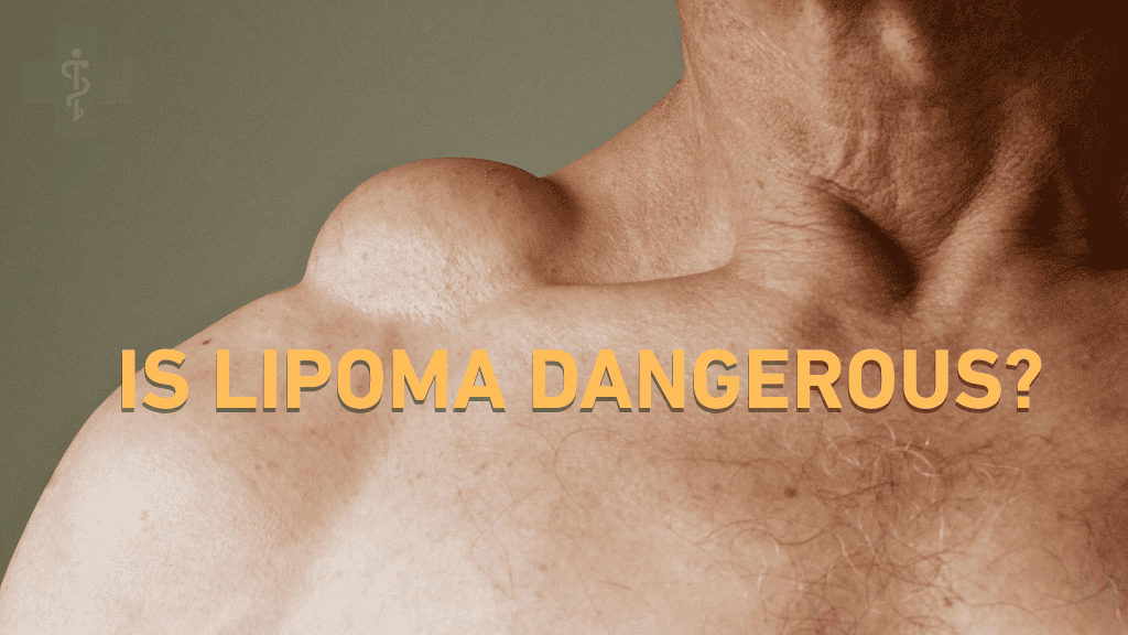Is Lipoma Dangerous