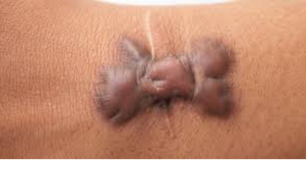 Keloid Treatment in Katihar