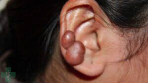 Best Treatment for Keloid Scars