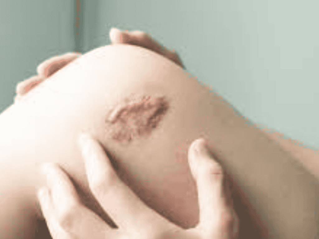 Keloid Treatment in Patna