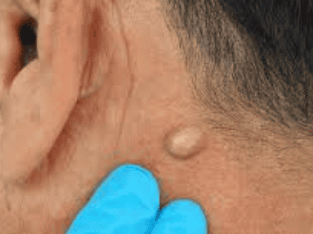 Lipoma Treatment in Pune