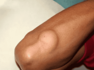 Lipoma Treatment in Gaya