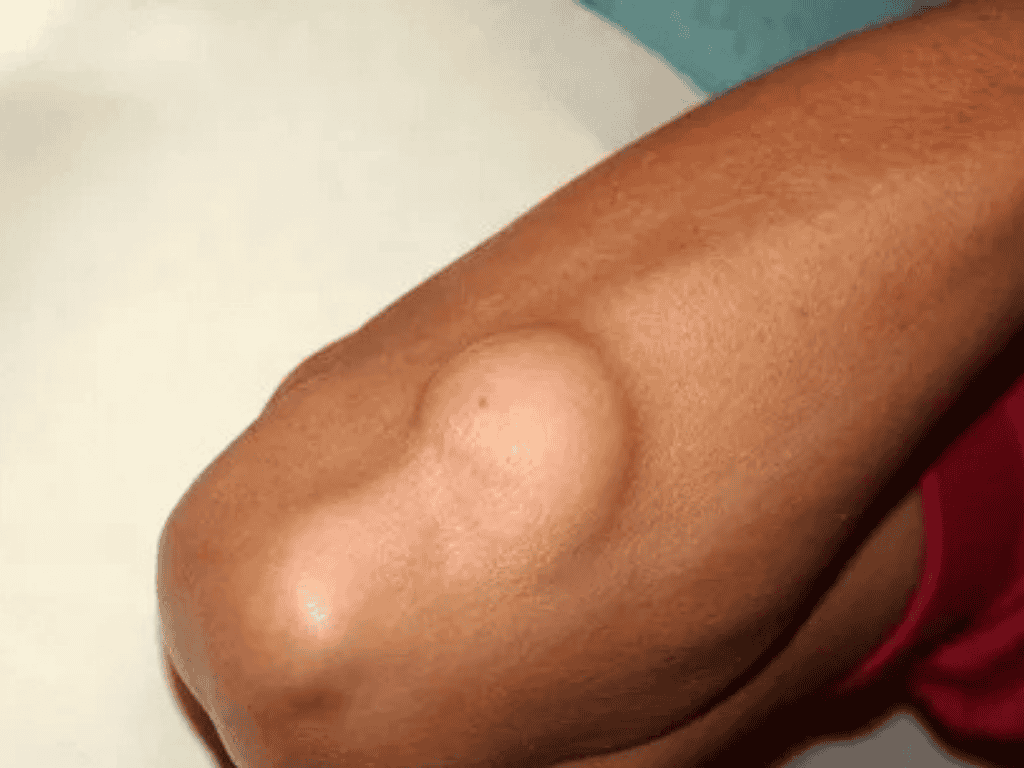 Lipoma Treatment in Gaya