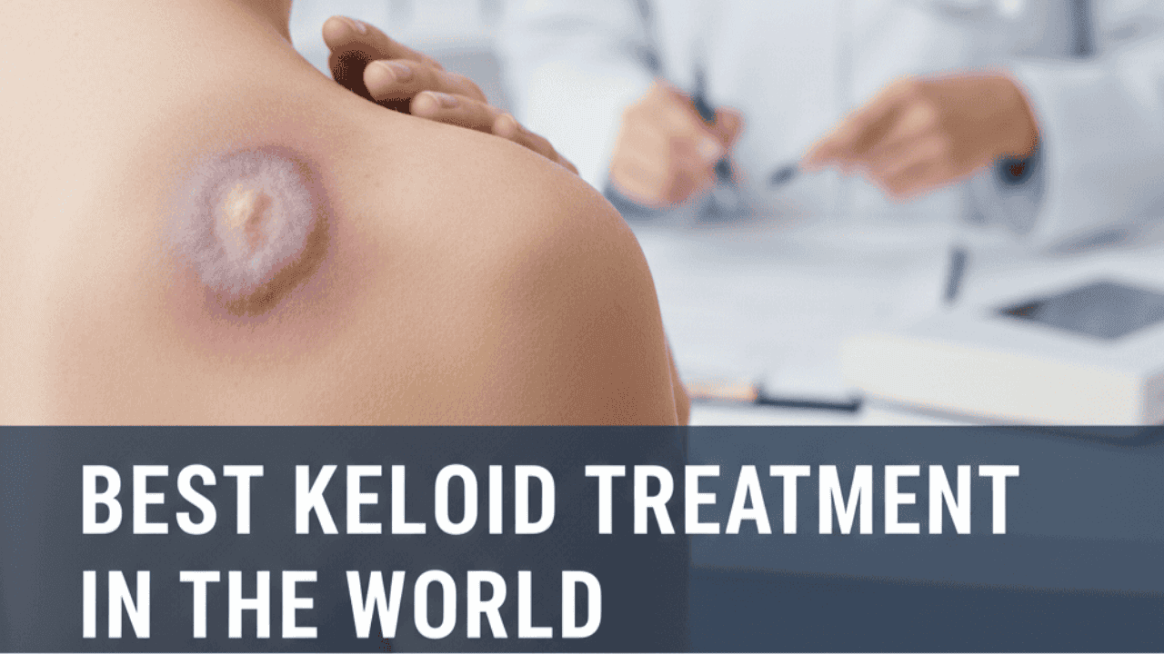 Best keloid treatment in the world