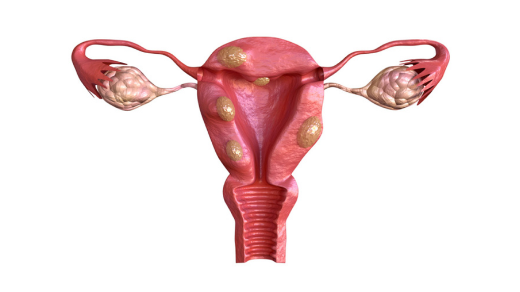 uterine fibroids