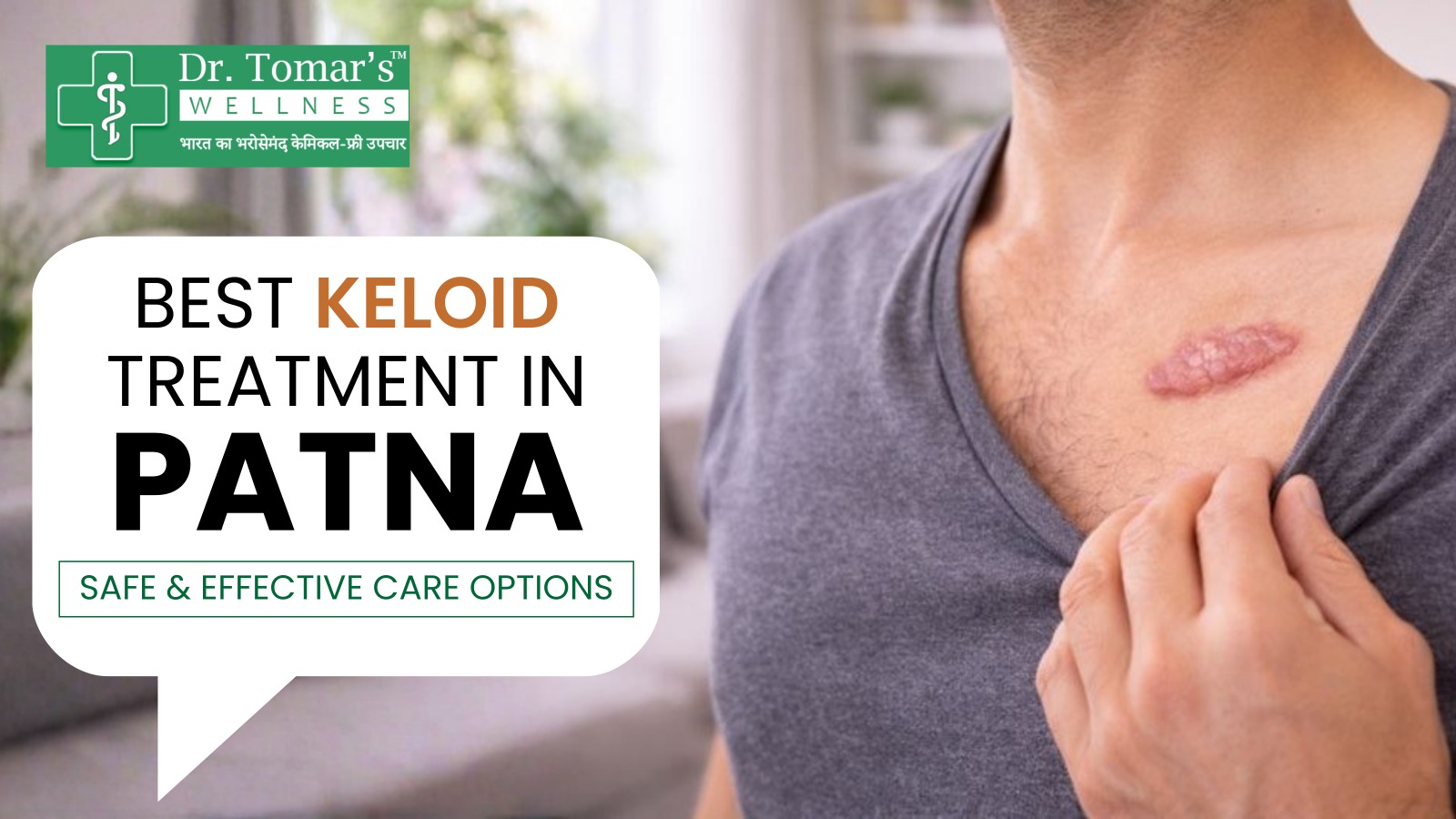 Keloid Treatment in Patna