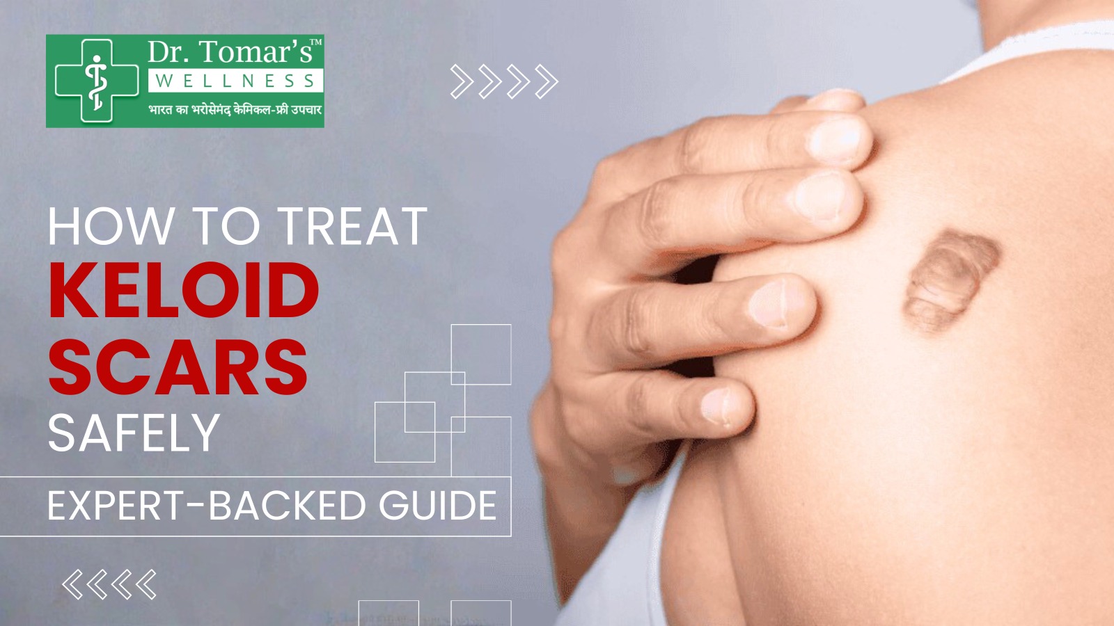Best Treatment for Keloid Scars