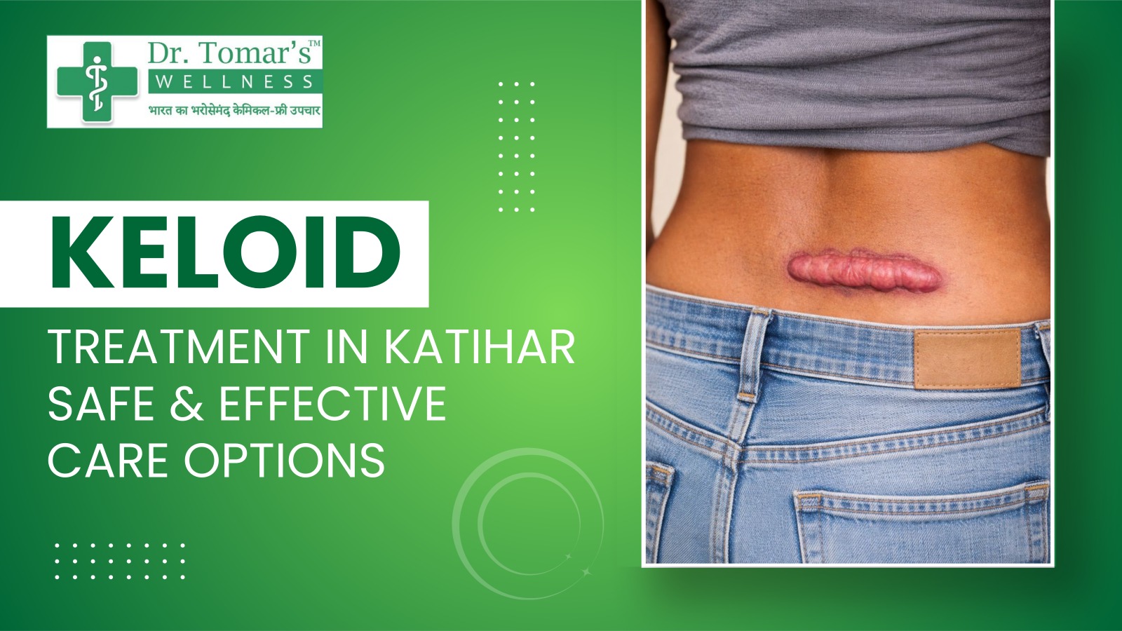 Keloid Treatment in Katihar