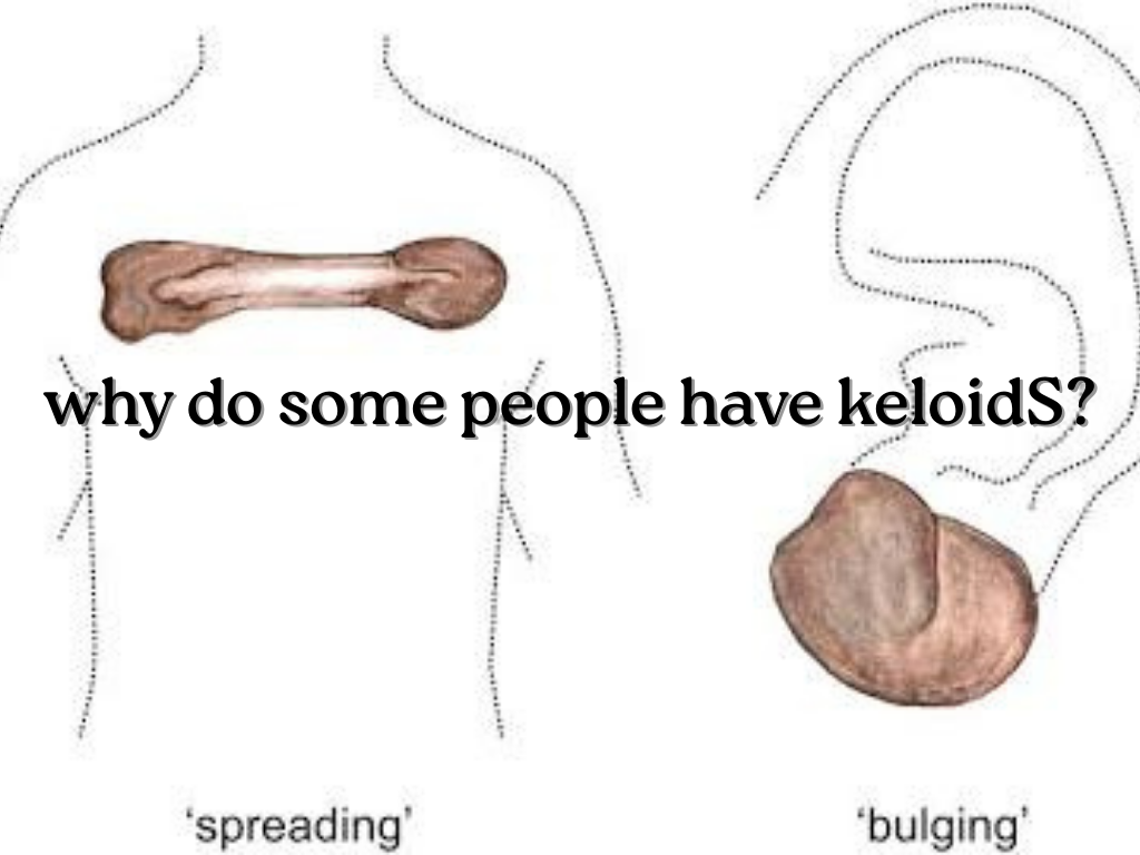 why do some people get keloids
