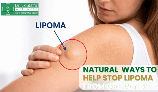stop lipoma from growing