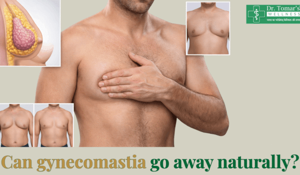 gynecomastia