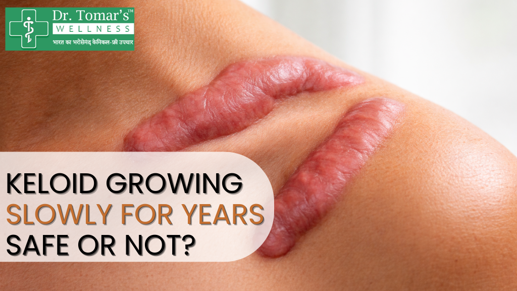 keloid growing slowly for years safe or not? 1 keloid growing slowly