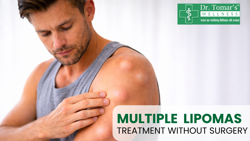 Multiple Lipomas Treatment Without Surgery – Is It Possible? 1 Multiple Lipomas
