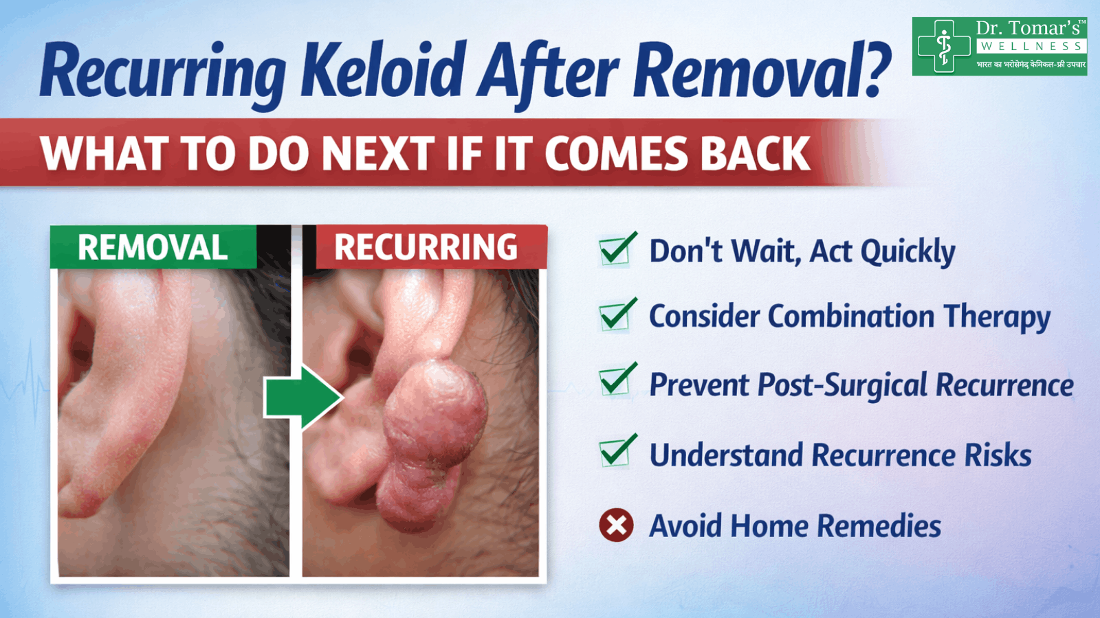 Recurring keloid after removal what to do 1 recurring keloid after removal