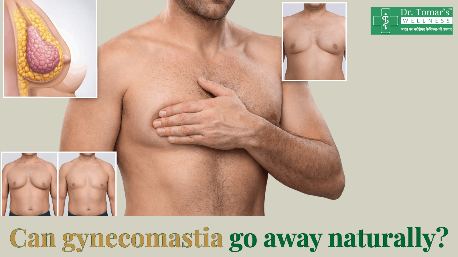 How do I know if I have gynecomastia or just chest fat? 1 gynecomastia