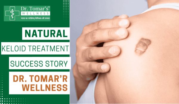 Keloid Treatment Success Story