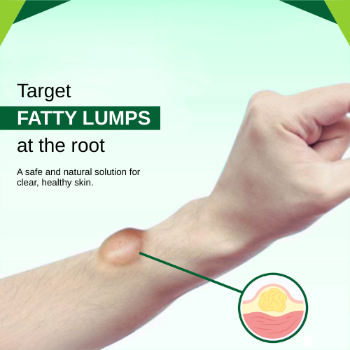 lipoma control cream,fatty lumps