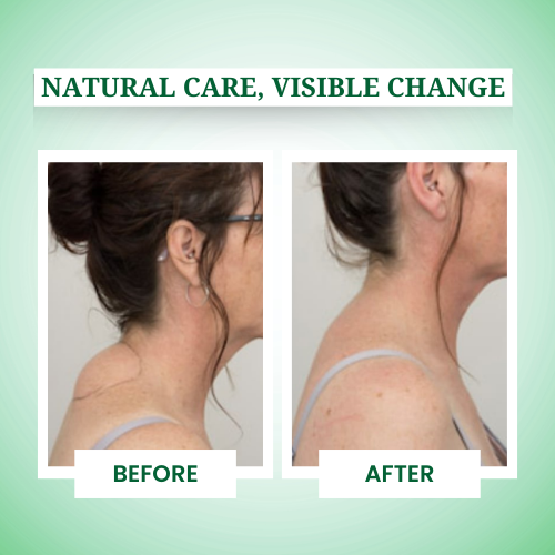 lipoma control cream,fatty lumps