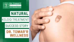 Keloid Treatment Success Story